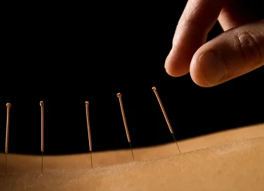 Acupuncture &amp; Red Light for Cosmetic Anti-Aging