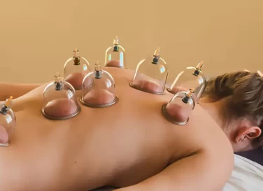 Cupping For Pain Relief and Relaxation